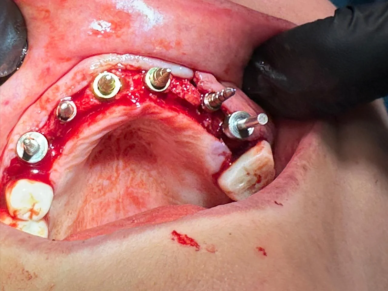 Intraoral clinical photograph showing implant components during a surgical procedure
